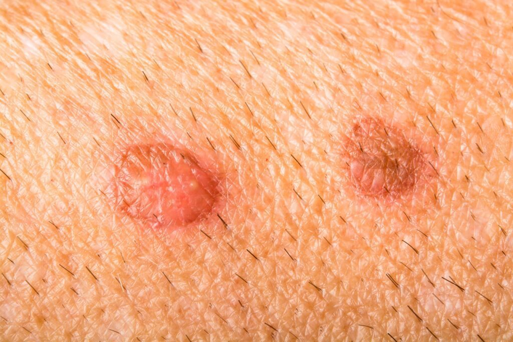 Lire la suite à propos de l’article Huiles essentielles pour les infections cutanées: lorsque ces germes ne laissent pas votre peau seule!